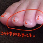 足の爪が皮膚に食い込む件